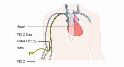 chemo-picc-line-101