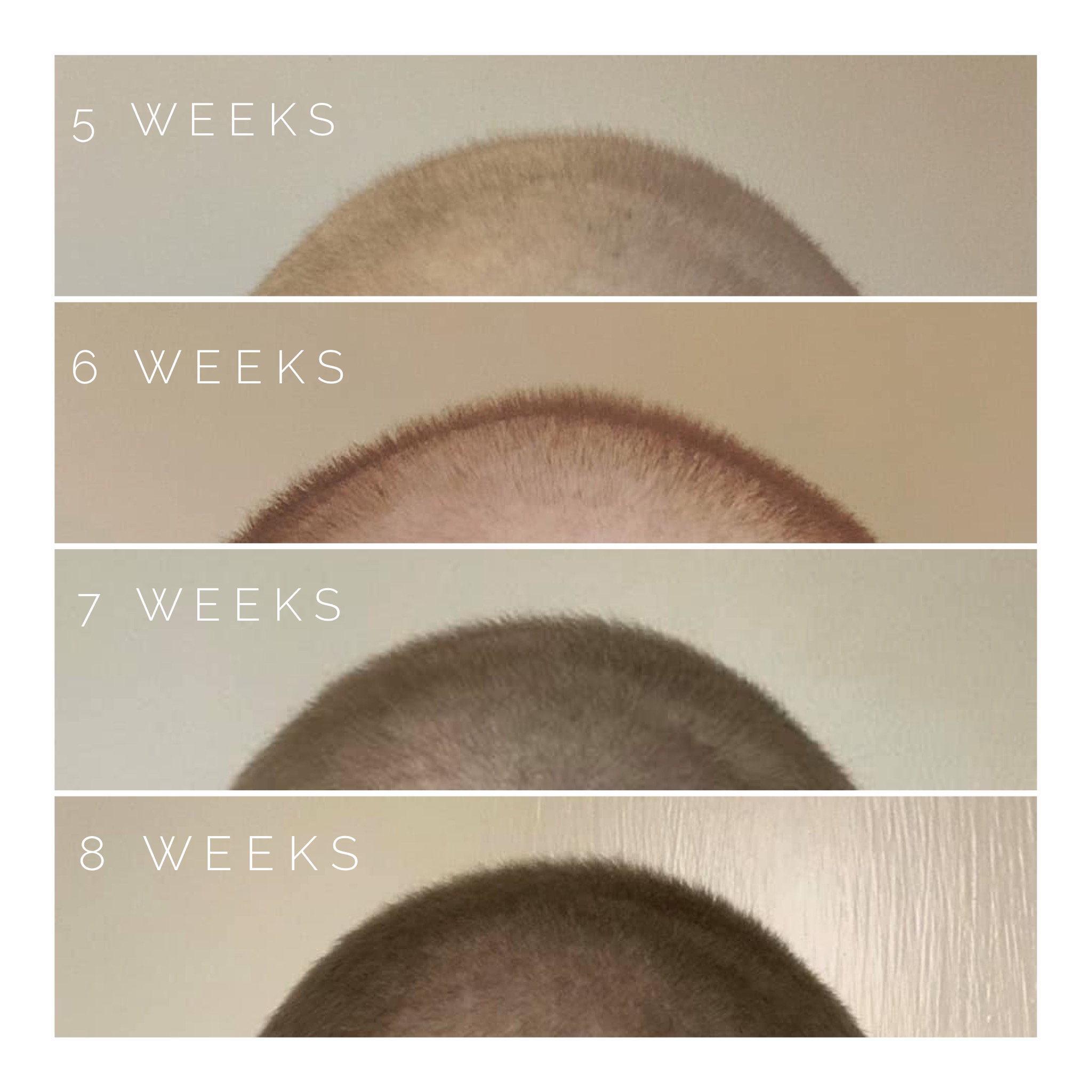 Befuzzled: Hair Growth After Chemo (Update 1) – The [Other] C Word